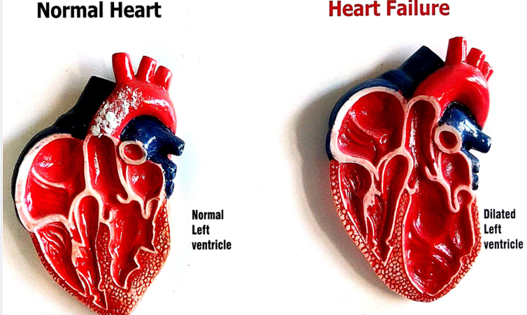 What is Heart Failure?