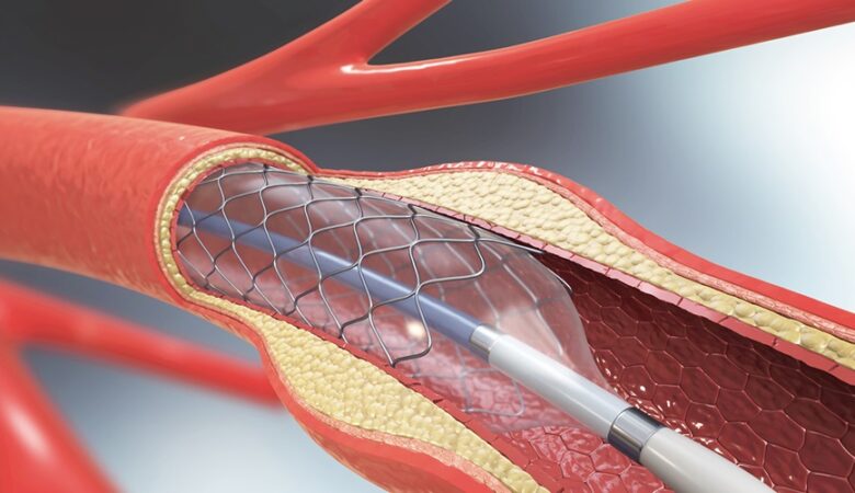 What Happens During Angioplasty? A Simple Guide