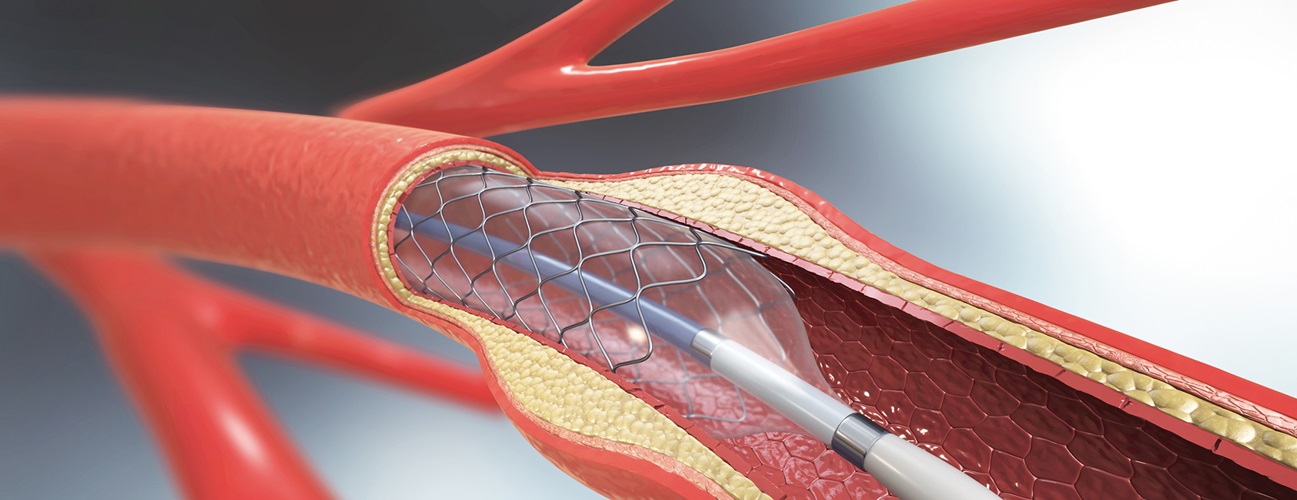 What Happens During Angioplasty? A Simple Guide