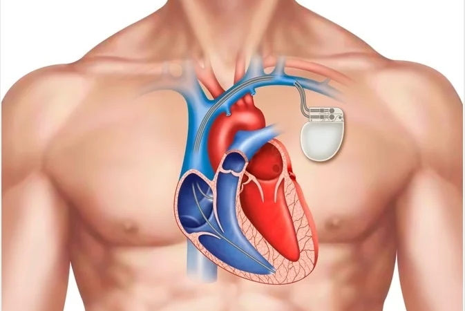 Diet tips for pacemaker patients: Foods to eat and avoid.