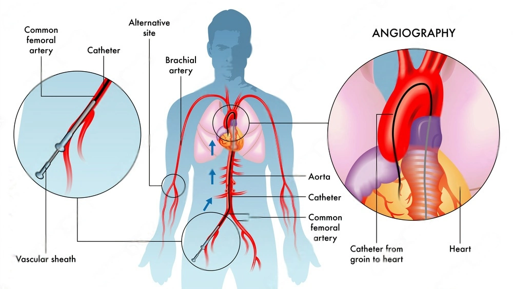 Angiography in Pune