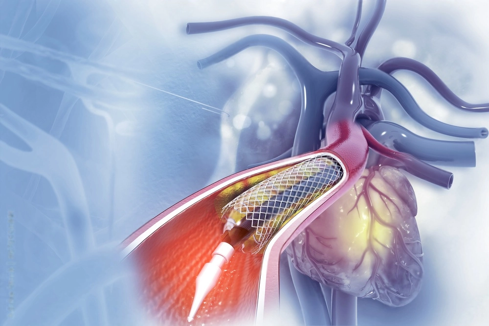 Coronary Angioplasty Treatment in Pune