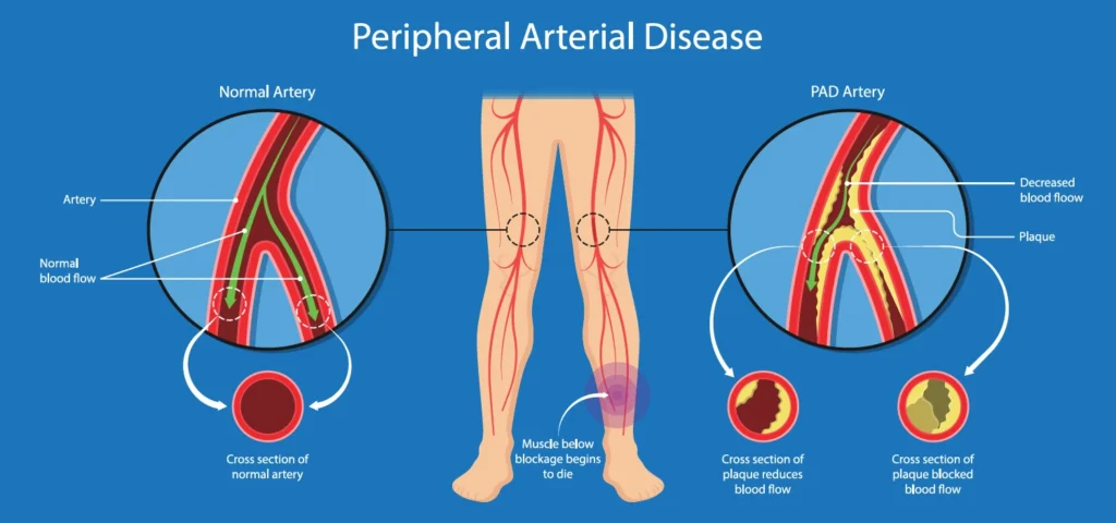 Peripheral Angiography and Angioplasty