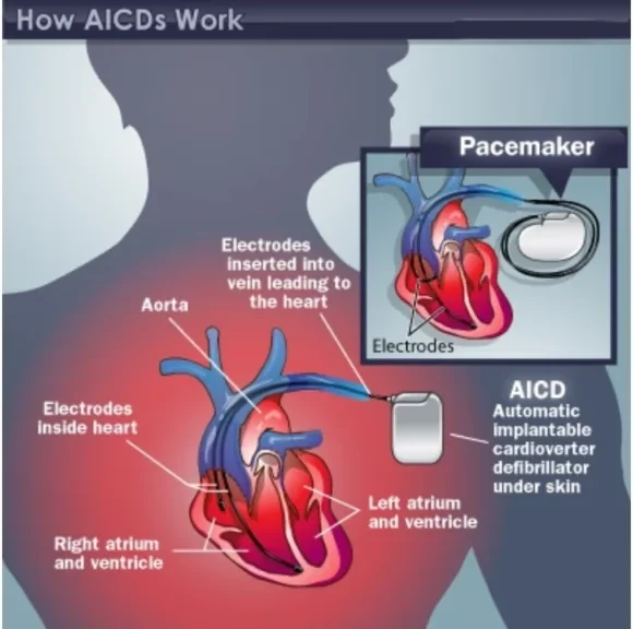 AICD Implantation in Pune