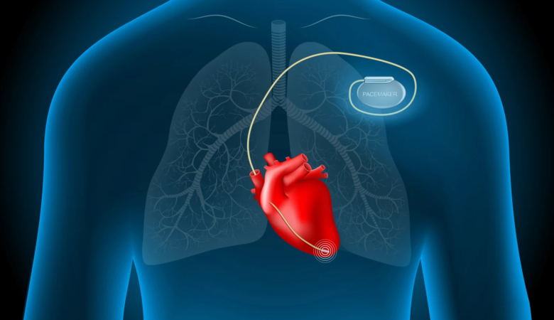 How a Pacemaker Can Improve Your Heart Health